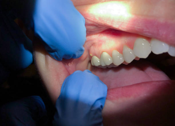 Emergency Dental Filling Replacement in SD